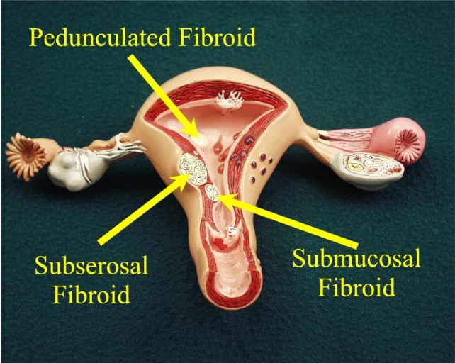 how fibroids are measured