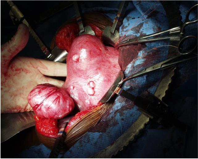 how fibroids are measured