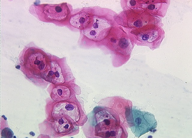 a papilloma condyloma diatermokoagulációja papilloma vírus, amely teszteket végez