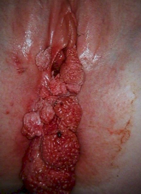 Genital wart inside the vagina 