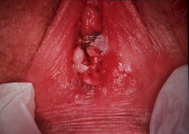 vulvar condyloma
